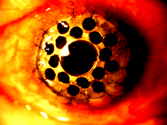 Edited photo of eye implants